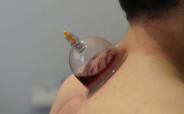 تعریف حجامت و 9 مورد از فواید آن